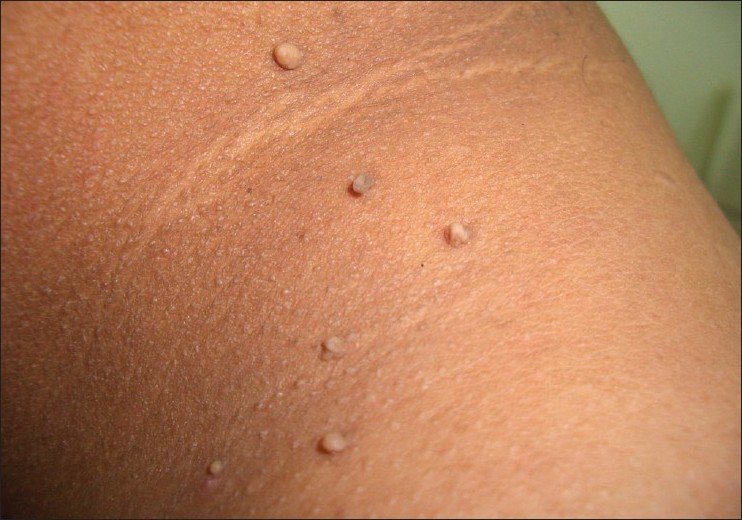 Skin Tag Removal in Mumbai