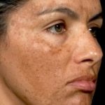 Pigmentation Treatment in Mumbai