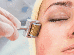 Dermaroller Treatment in Mumbai For Acne Scars – Cost, Procedure