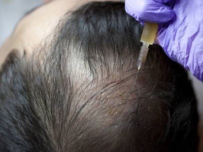 Hair Loss Treatment in Mumbai, Cost - Best Hair Specialist