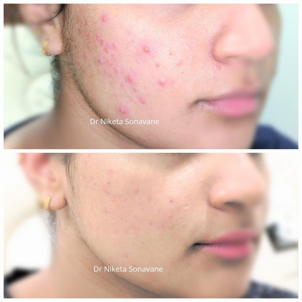 Acne Scar Treatment In Mumbai Cost Before After Results Laser 0927