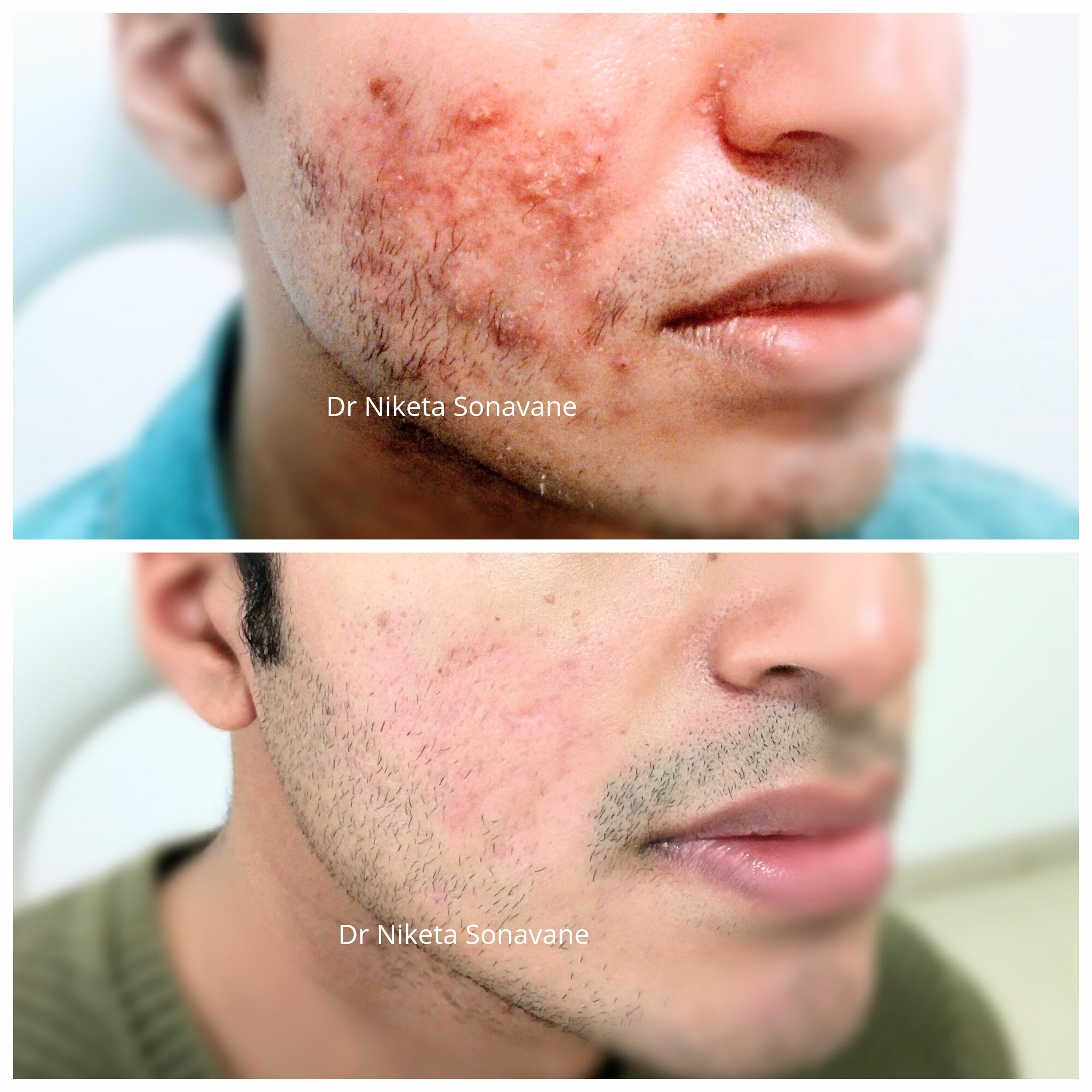 Acne Treatment In Mumbai - Cost, Before After, Laser, Acne Specialist