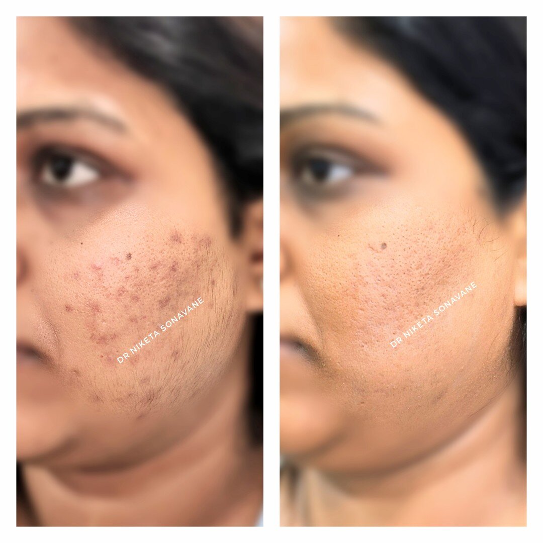 Kilde Undertrykke Numerisk Pigmentation Treatment in Mumbai - Cost, Before and After Results, Laser  Treatment