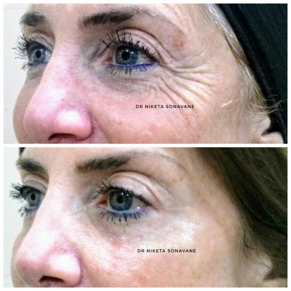 Botox in Mumbai, crows feet Botox treatment in Mumbai, before after