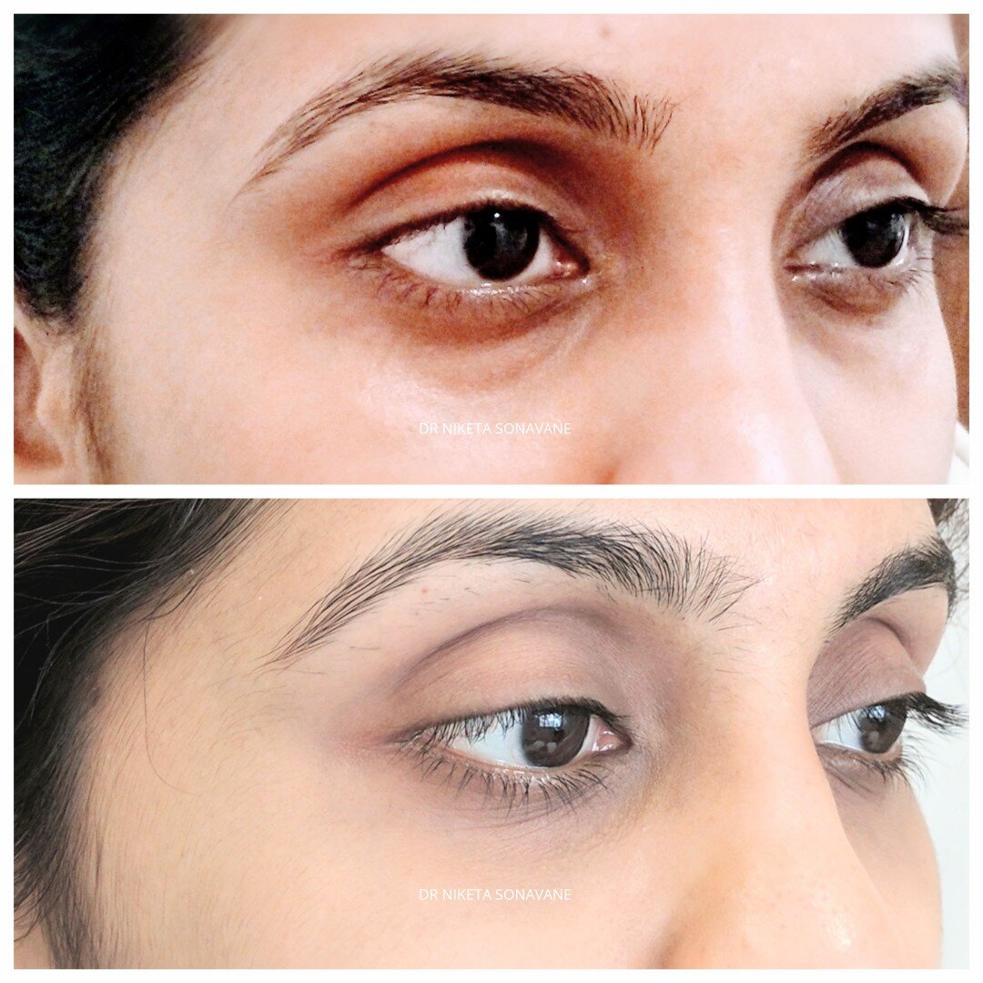 Dark Circles Treatment in Mumbai - Cost, Before After, Laser Treatment