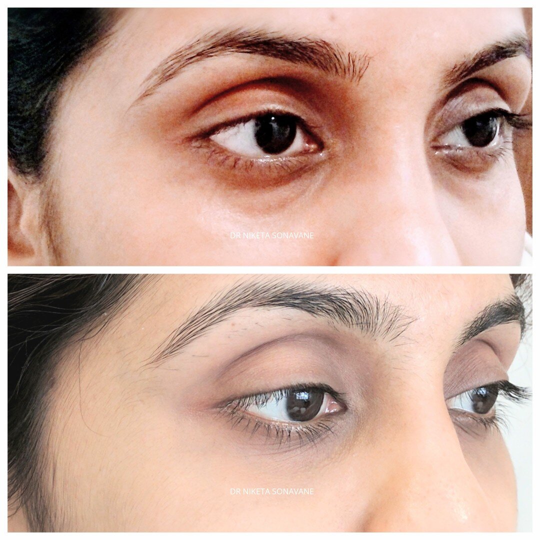 Dark Circle Removal In Mumbai Laser Treatment Filler Peel Cost