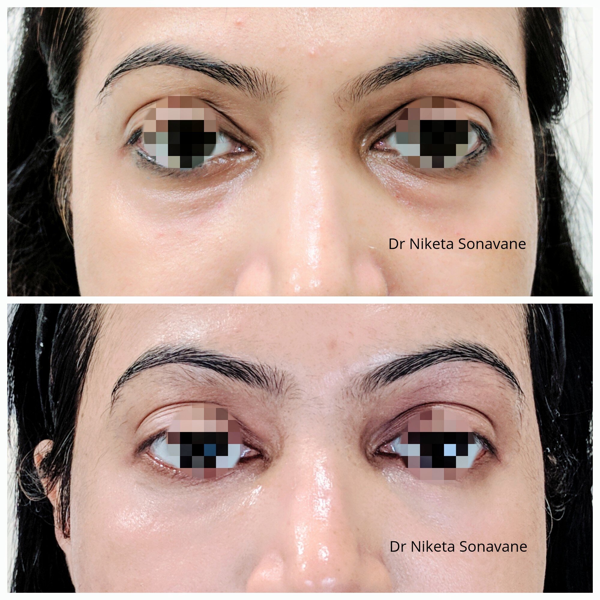 Bumps Under the Eyes - Causes and Treatment