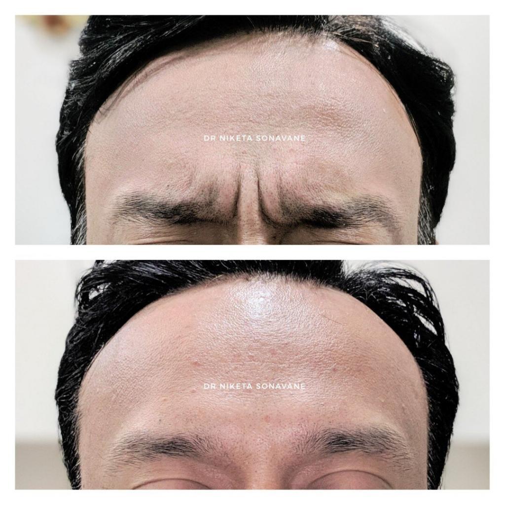 Botox, Botox, treatment, Botox injections, Botox in Mumbai, Botox treatment in Mumbai, Botox in men, Botox before after mumbai, Botox cost, Dr. Niketa Sonavane, Ambrosia Aesthetics, top dermatologist mumbai, dermatologist andheri west, celebrity dermatologist mumbai, Bollywood dermatologist, best dermatologist near me,