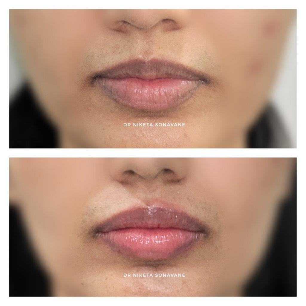 lip filler in Mumbai, dermal filler in Mumbai, Juvederm lip filler, Volbella lip filler, lip filler before after, lip enhancement, lip augmentation, lip injections, lip filler, dr niketa sonavane, best dermatologist in mumbai, 