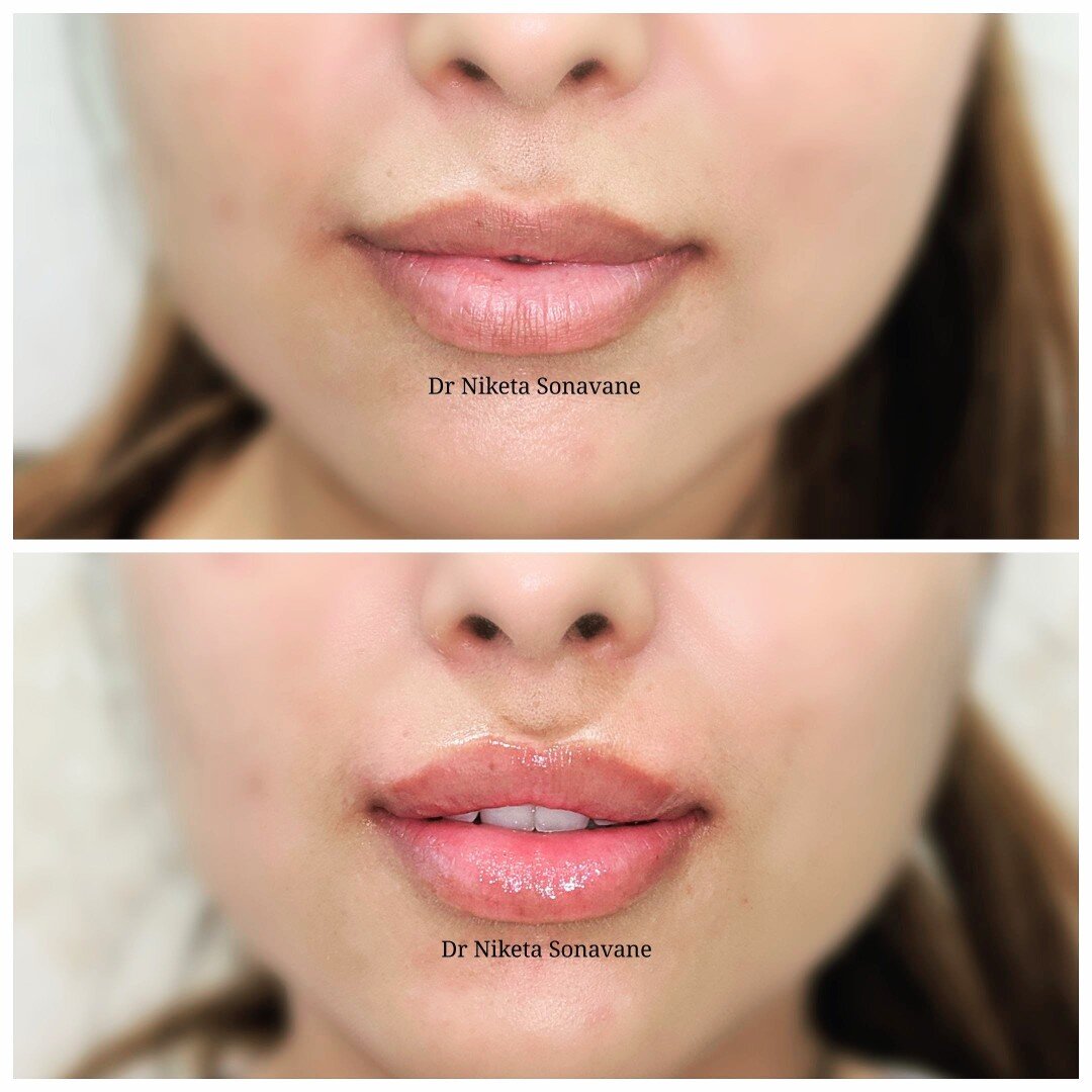 if-you-ever-wondered-how-1-syringe-vs-2-syringes-of-lip-filler-look