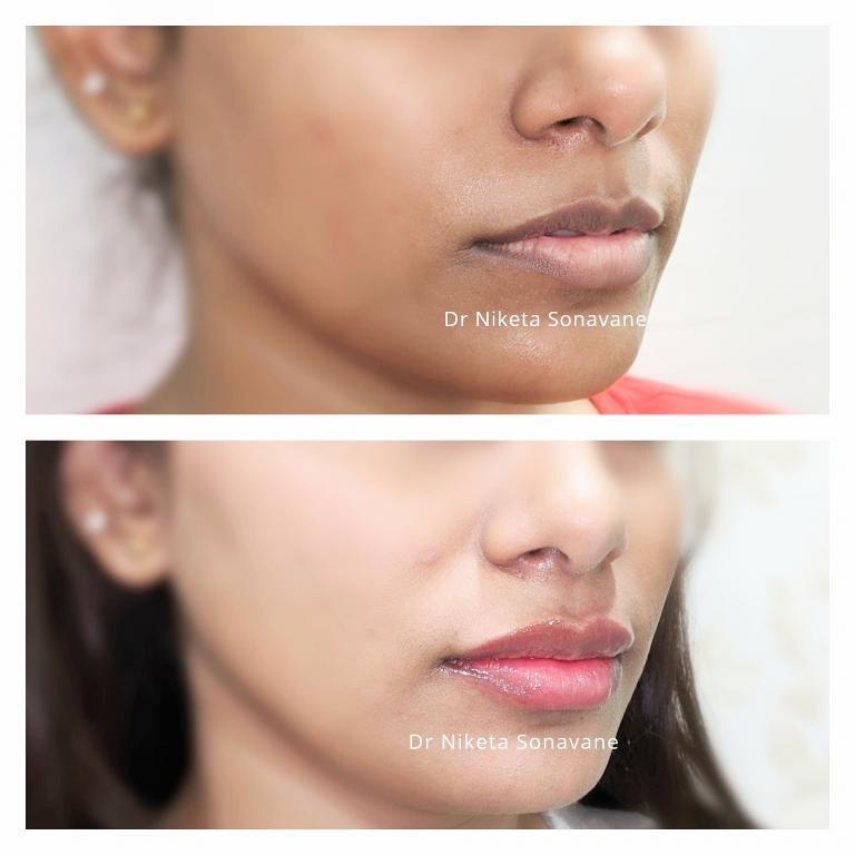 dermal filler, dermal filler cheeks, dermal filler Mumbai, dermal filler before after, dermal filler cost mumbai, Juvederm XC mumbai, Juvederm XC cost mumbai, lip filler, lip filler mumbai, lip filler before after, lip filler cost mumbai, Juvederm Volbella, Volbella XC cost Mumbai, lip lightening treatment, lip lightening treatment Mumbai, lip lightening treatment before after, lip lightening treatment cost mumbai, laser lip lightening mumbai, laser lip lightening cost, skin whitening treatment, skin whitening treatment Mumbai, body whitening treatment, skin whitening treatment before after, skin whitening treatment cost mumbai, glutathione injections, gluta injection, L glutathione injection, glutathione injections cost, glutathione iv drip, glutathione injections side effects, gluta iv drip, glutathione iv treatment, glutathione injections mumbai, Dr. Niketa Sonavane, Ambrosia Aesthetics, top dermatologist mumbai, dermatologist andheri west, celebrity dermatologist mumbai, Bollywood dermatologist, best dermatologist near me,