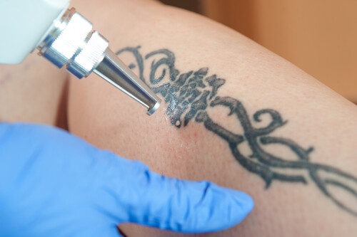 Can Tattoos be Removed? Tattoo Removal - NAAMA Studios