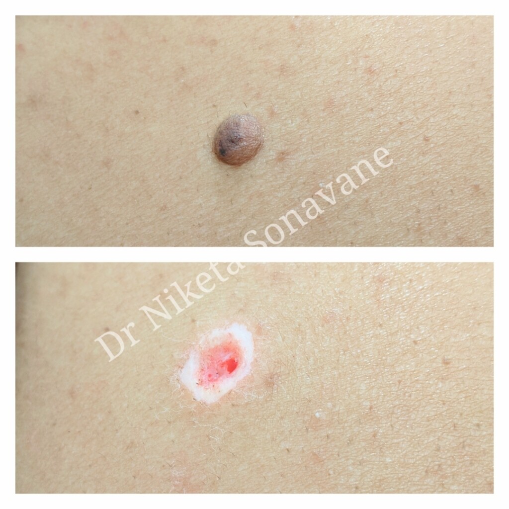 Mole removal, Mole removal Mumbai, milia removal, molluscum removal, best Dermatologist in Mumbai, mole removal before and after, Dr Niketa Sonavane