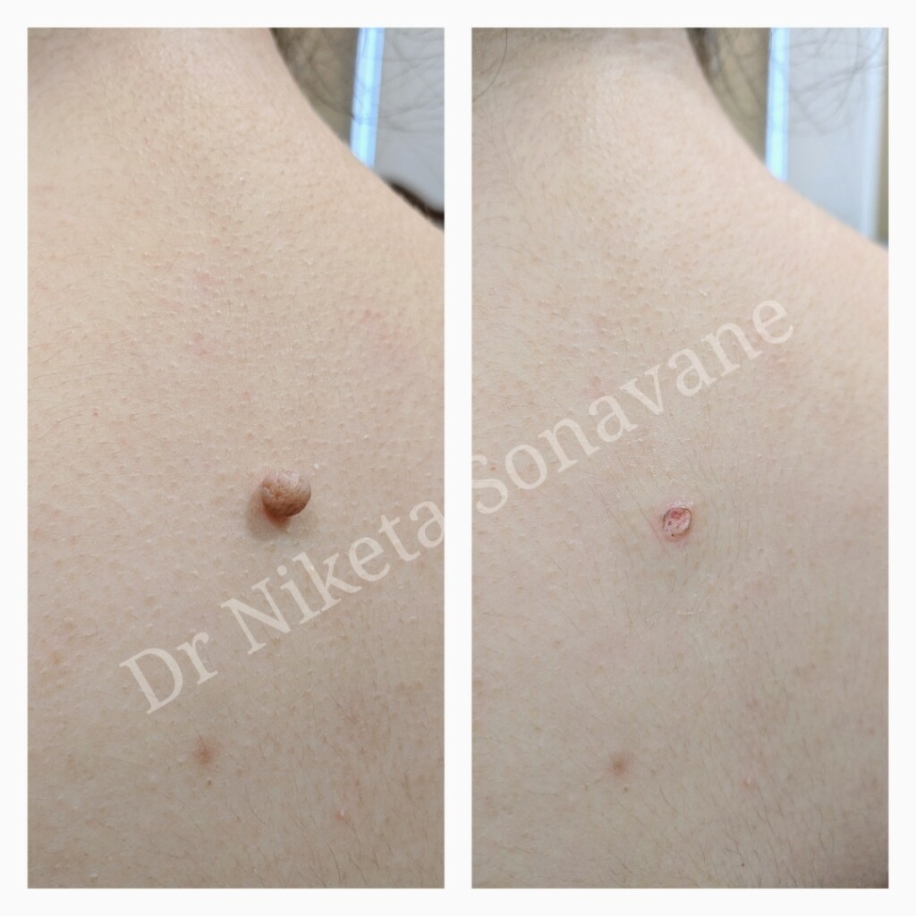 Mole removal, Mole removal Mumbai, milia removal, molluscum removal, best Dermatologist in Mumbai, mole removal before and after, Dr Niketa Sonavane