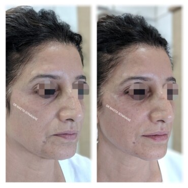 Dermatologist In Mumbai, Skin Treatment Before And After Photos