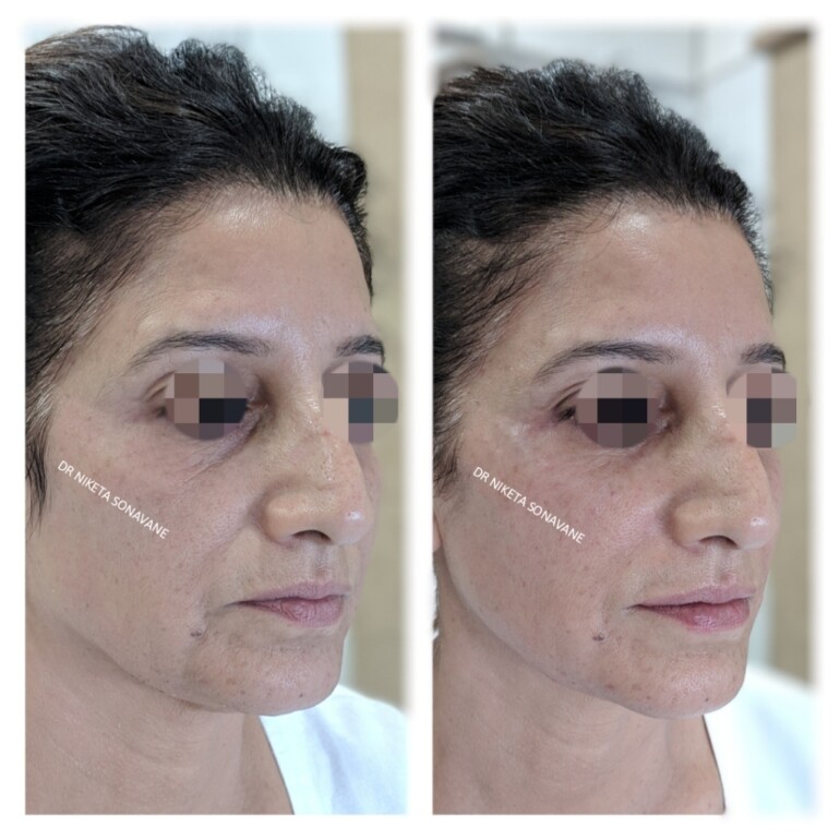 Acne Treatment In Mumbai Cost Before After Laser Acne Specialist