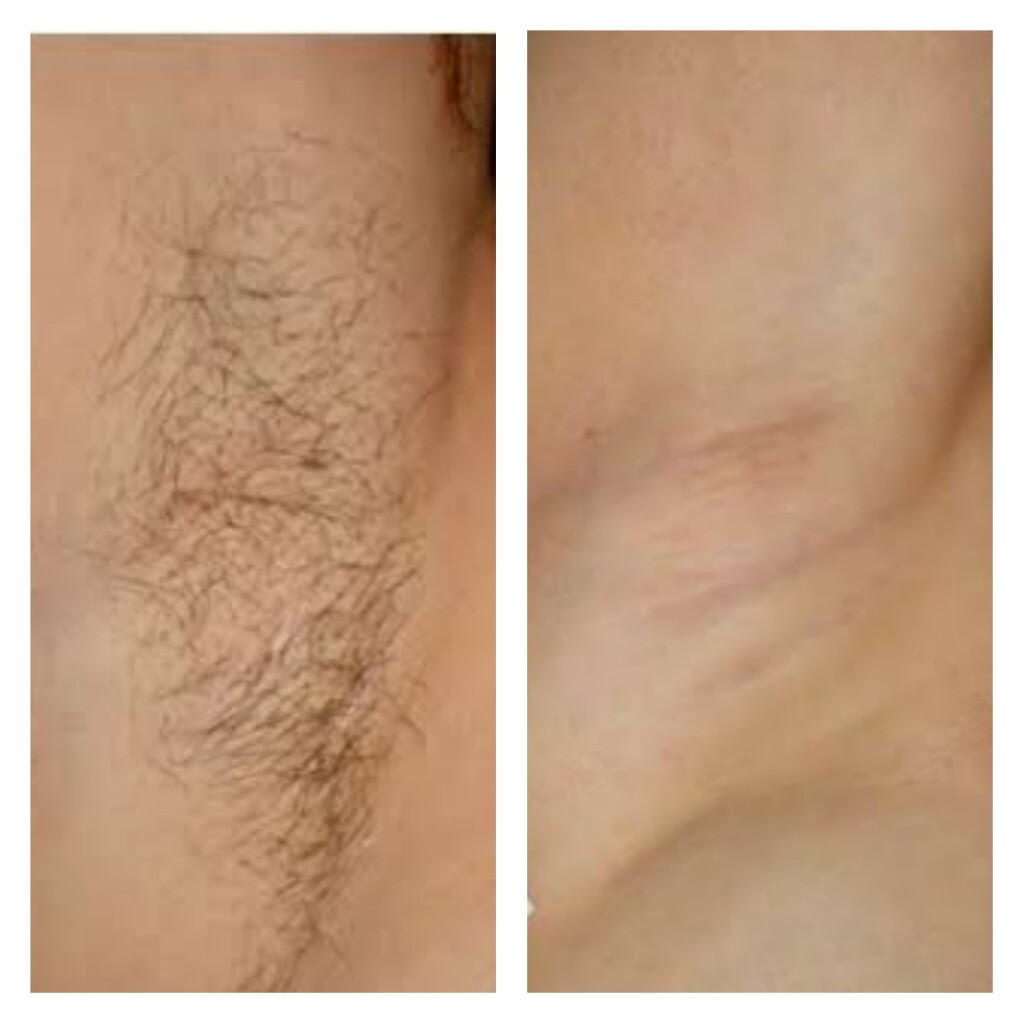 Laser Hair Removal in Mumbai - Cost, Discount, Painless, Full Body Laser