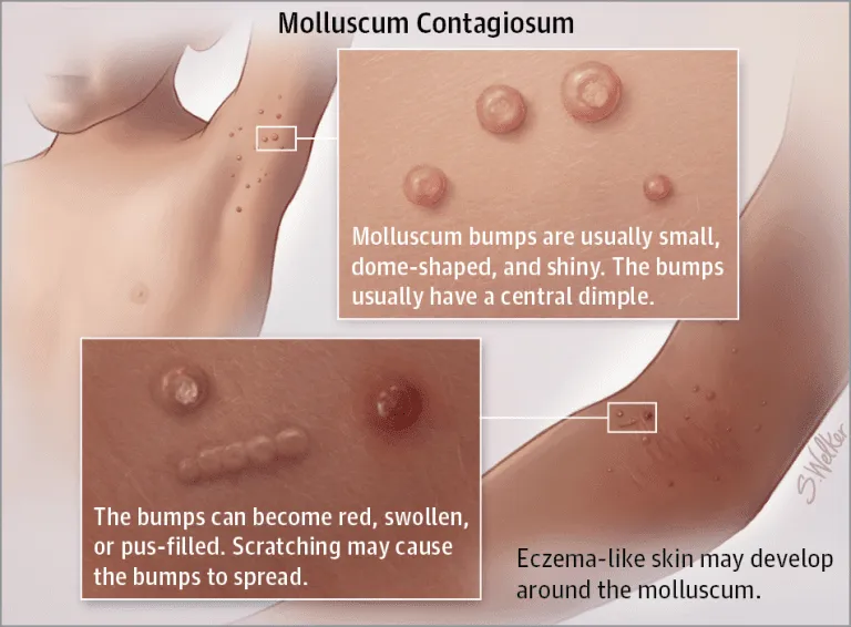 Molluscum contagiosum treatment in Mumbai, Dr Niketa Sonavane